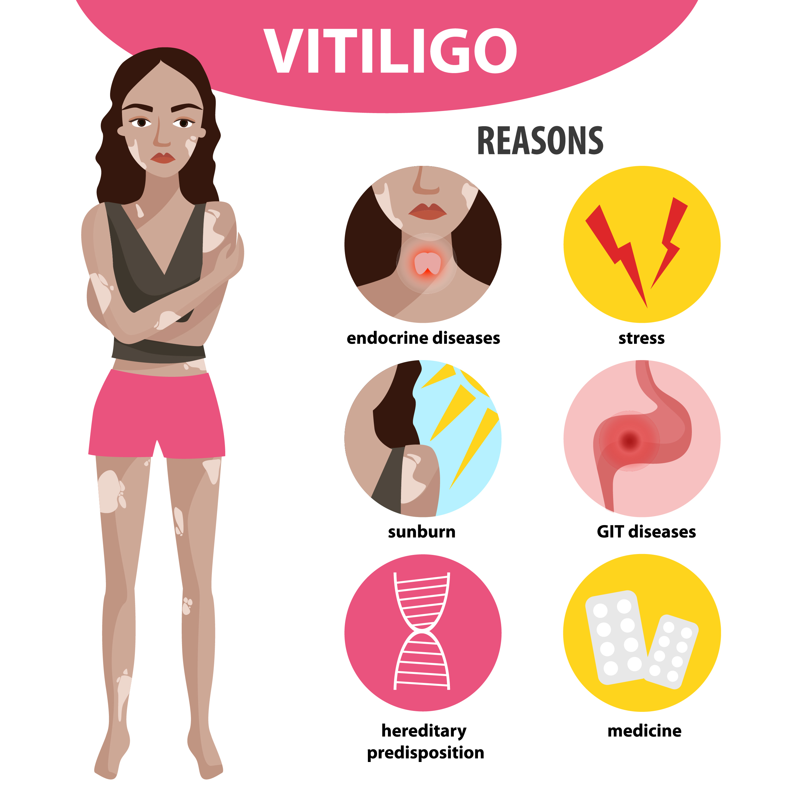 What causes vitiligo
